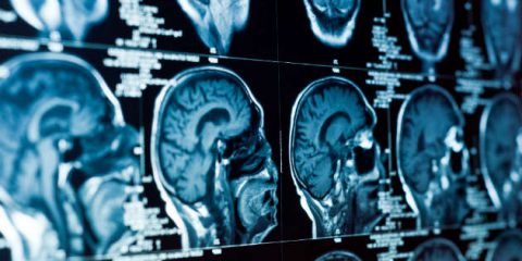 Intelligenza artificiale, tecnologia italiana contro Alzheimer e Parkinson