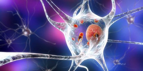 Nanoplastiche, nuovo studio lega l’inquinamento al Parkinson e altre forme di demenza precoce