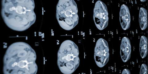 L’AI per diagnosticare in anticipo il cancro al pancreas, lo studio PRIMIS del MIT e il progetto PANCAIM dell’Ue